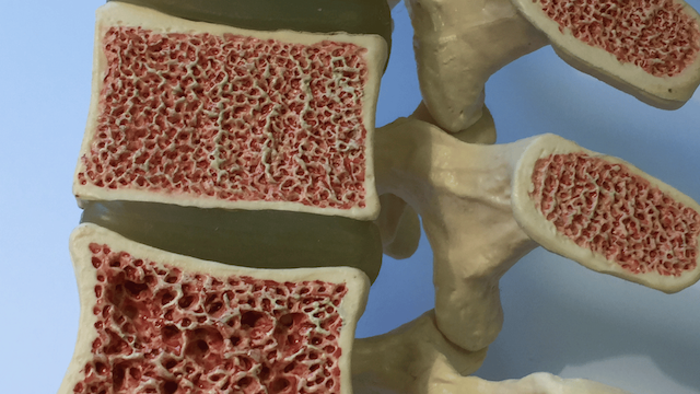 Osteoporosis and Bone Health